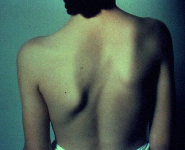 Malattia di Sprengel come causa di dolore sotto la scapola sinistra