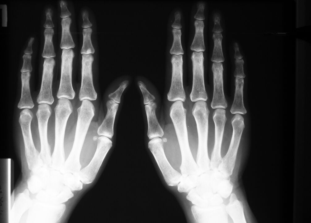 radiografia per diagnosticare il dolore alle articolazioni delle dita