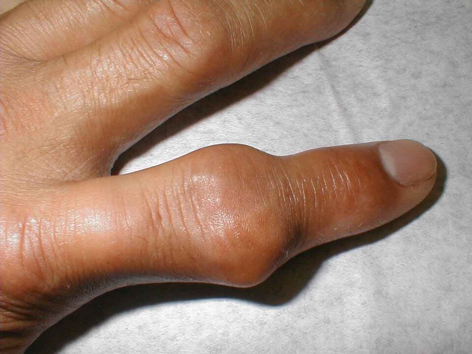 tophi nell'articolazione delle dita come causa di dolore