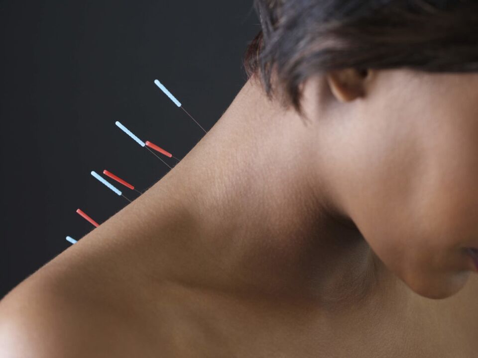L'agopuntura per l'osteocondrosi cervicale elimina i processi infiammatori
